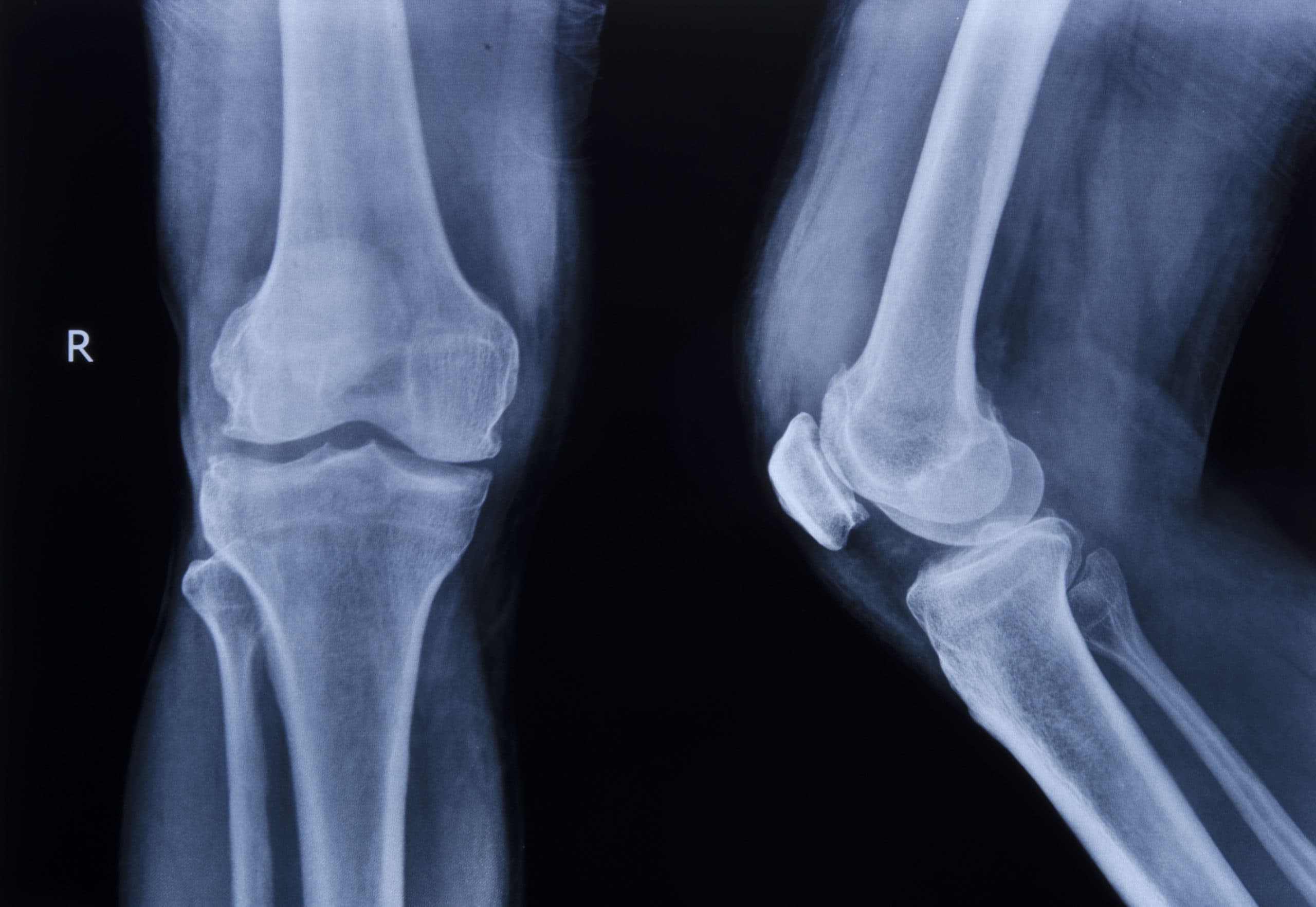 Pre-operative knee x-ray review